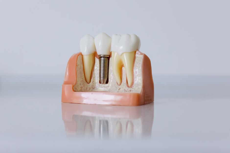 Dental implant model showing post and crown, illustrating dental implants cost without insurance